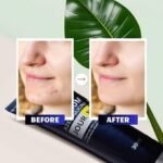 ⁦Azeloglicina 5%⁩ - الصورة ⁦2⁩